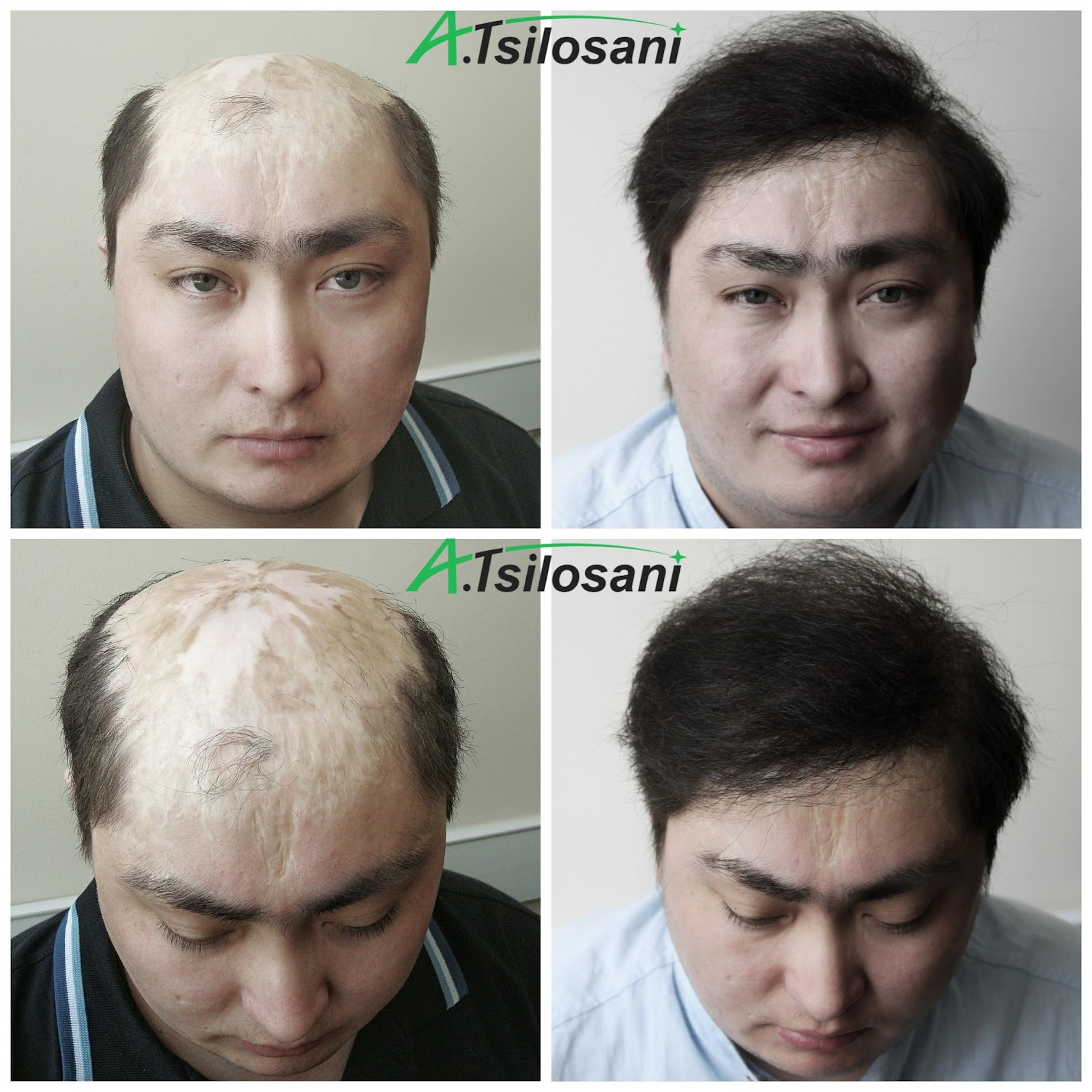FUE Before and After